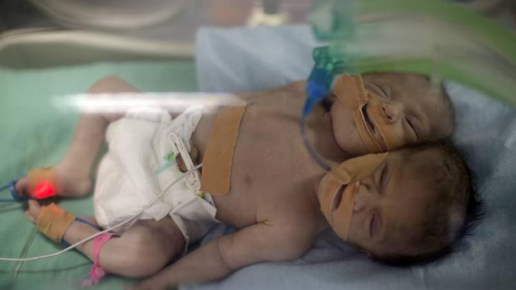 PALESTINIAN-ISRAEL-TWINS-MEDICINE