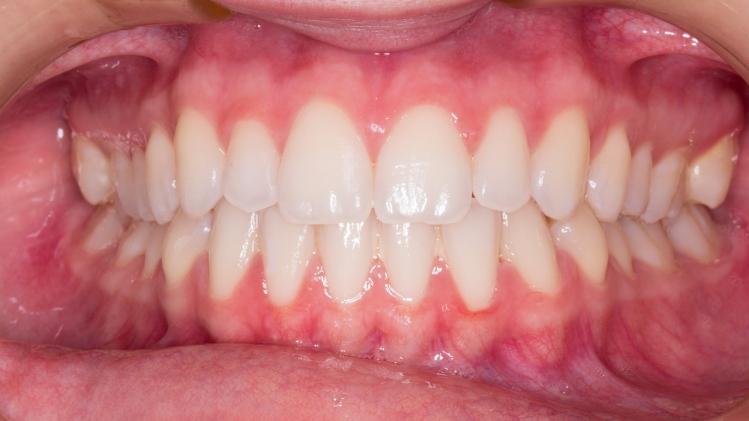 Les 5 erreurs qui ruinent vos dents sans que vous le sachiez