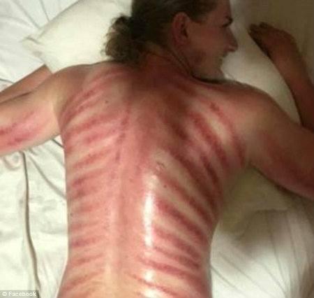 why-you-should-always-ask-australian-left-with-red-marks-on-back-after-red-dragon-massage-in-bali-1.jpg