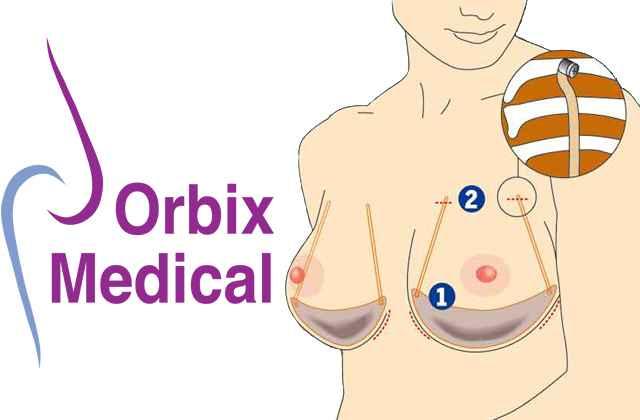 orbix_medical_soutien-gorge_invisible.jpg
