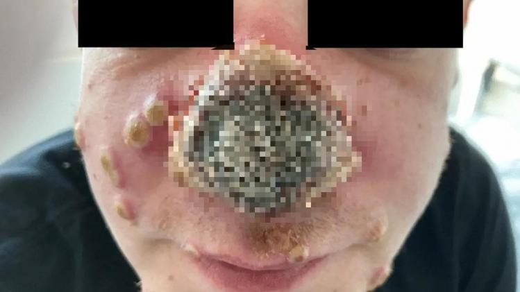 monkeypox-german-male-case-study-redacted_dot_app