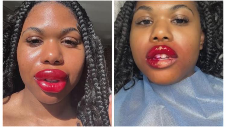 Cette influenceuse n’aurait pas dû se faire tatouer les lèvres… (vidéo)