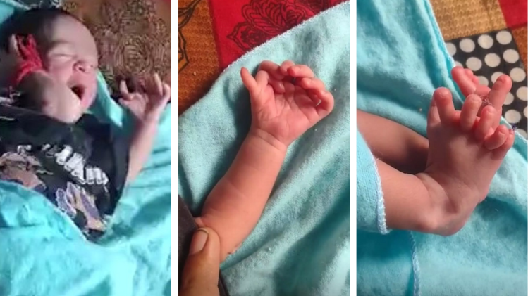 Baby born with 26 fingers and toes hailed as ‘reincarnation of Hindu goddess