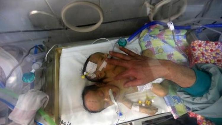 Siamese tweeling in burgeroorlogland Jemen overleden