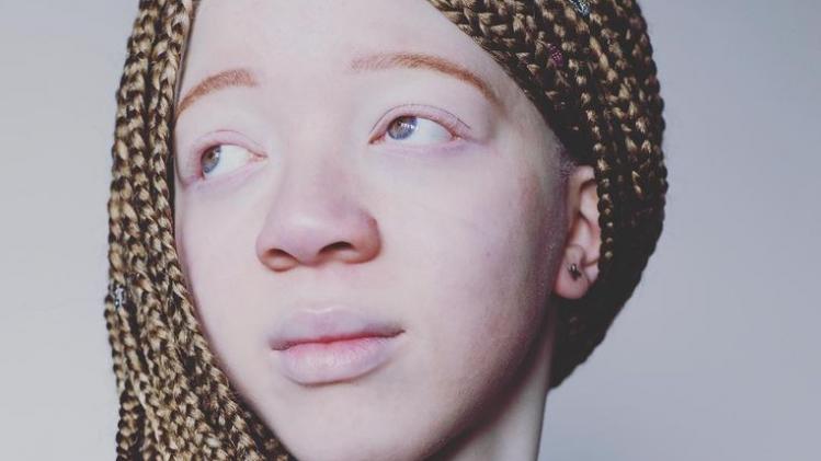 Tienermodel met albinisme verschijnt in Italiaanse Vogue