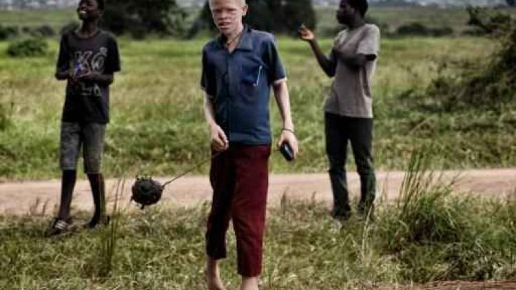 Amnesty International roept op tot bescherming van albino's in Malawi