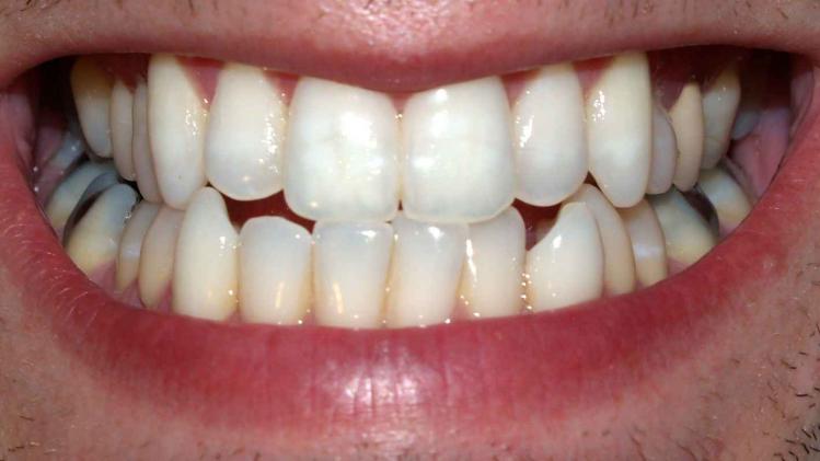 Teeth_by_David_Shankbone