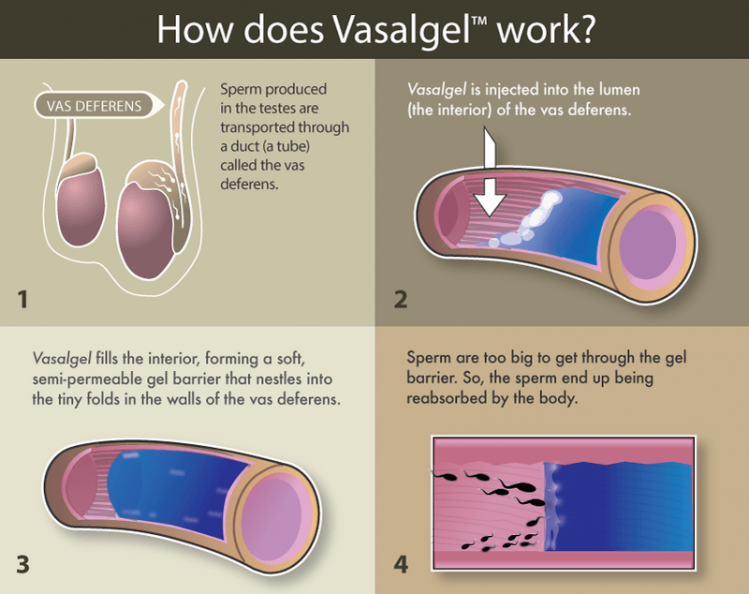 Vasalgel_Infographic_Lina-WEB.png